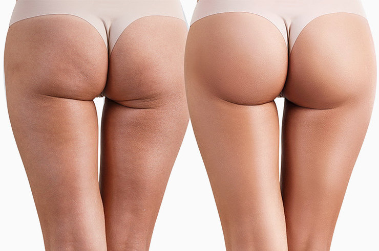 Ким Кардашьян лопнет от зависти: 5 эффективных упражнений для красивой попы!